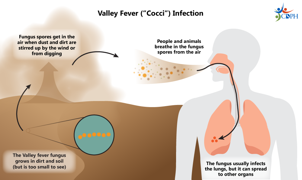 Valley fever treatment